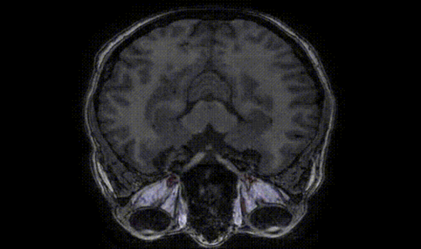 Estimation of Fat and Muscle Volume of Human Eyes